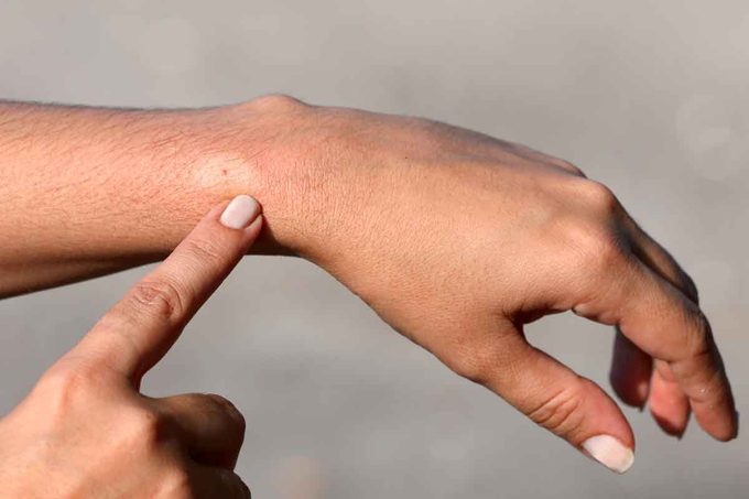 What to Do When a Wasp Stings You